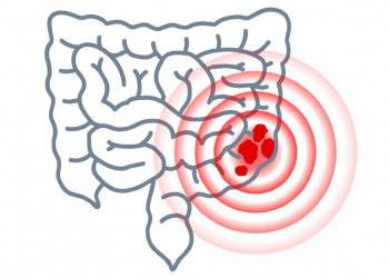 Colonoscopia vs. biomarcadores en cáncer colorrectal.